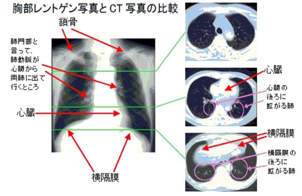 肺がんct健診 アスベスト健診 庄司クリニック 新型コロナpcr検査 金沢区 金沢文庫 すぐ出来る胸部ct 胃カメラ 大腸カメラ 新型コロナ Pcr検査 肺癌 胃がん 大腸癌 健診 胸部異常影 夜間診療 睡眠時無呼吸症候群