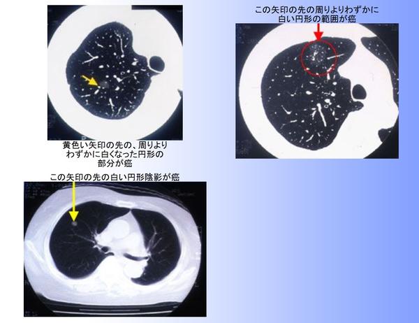 肺がんct健診 アスベスト健診 庄司クリニック 新型コロナpcr検査 金沢区 金沢文庫 すぐ出来る胸部ct 胃カメラ 大腸カメラ 新型コロナ Pcr検査 肺癌 胃がん 大腸癌 健診 胸部異常影 夜間診療 睡眠時無呼吸症候群