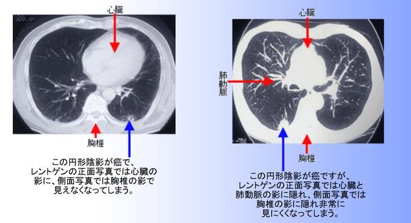 肺がんct健診 アスベスト健診 庄司クリニック 新型コロナpcr検査 金沢区 金沢文庫 すぐ出来る胸部ct 胃カメラ 大腸カメラ 新型コロナ Pcr検査 肺癌 胃がん 大腸癌 健診 胸部異常影 夜間診療 睡眠時無呼吸症候群